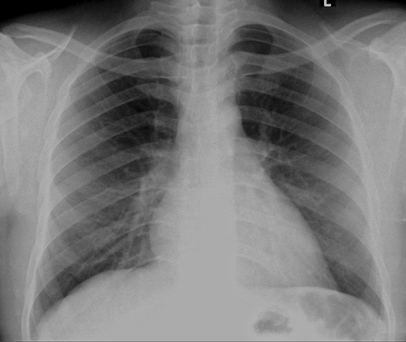 Digital X-ray