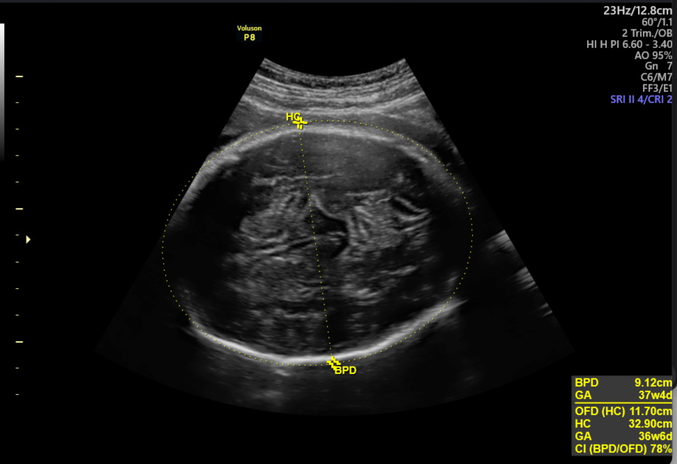 Ultrasound
